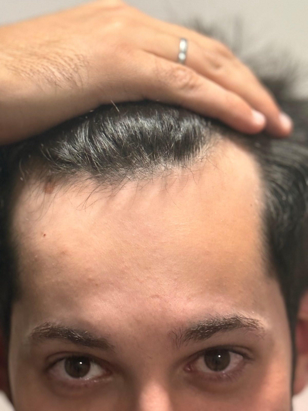 Vaquinha pro futuro implante capilar do Gu